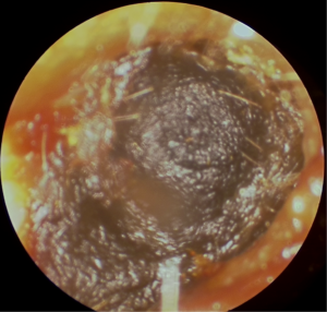 View of inside ear from otoscope. The ear canal is filled with dark ear wax.