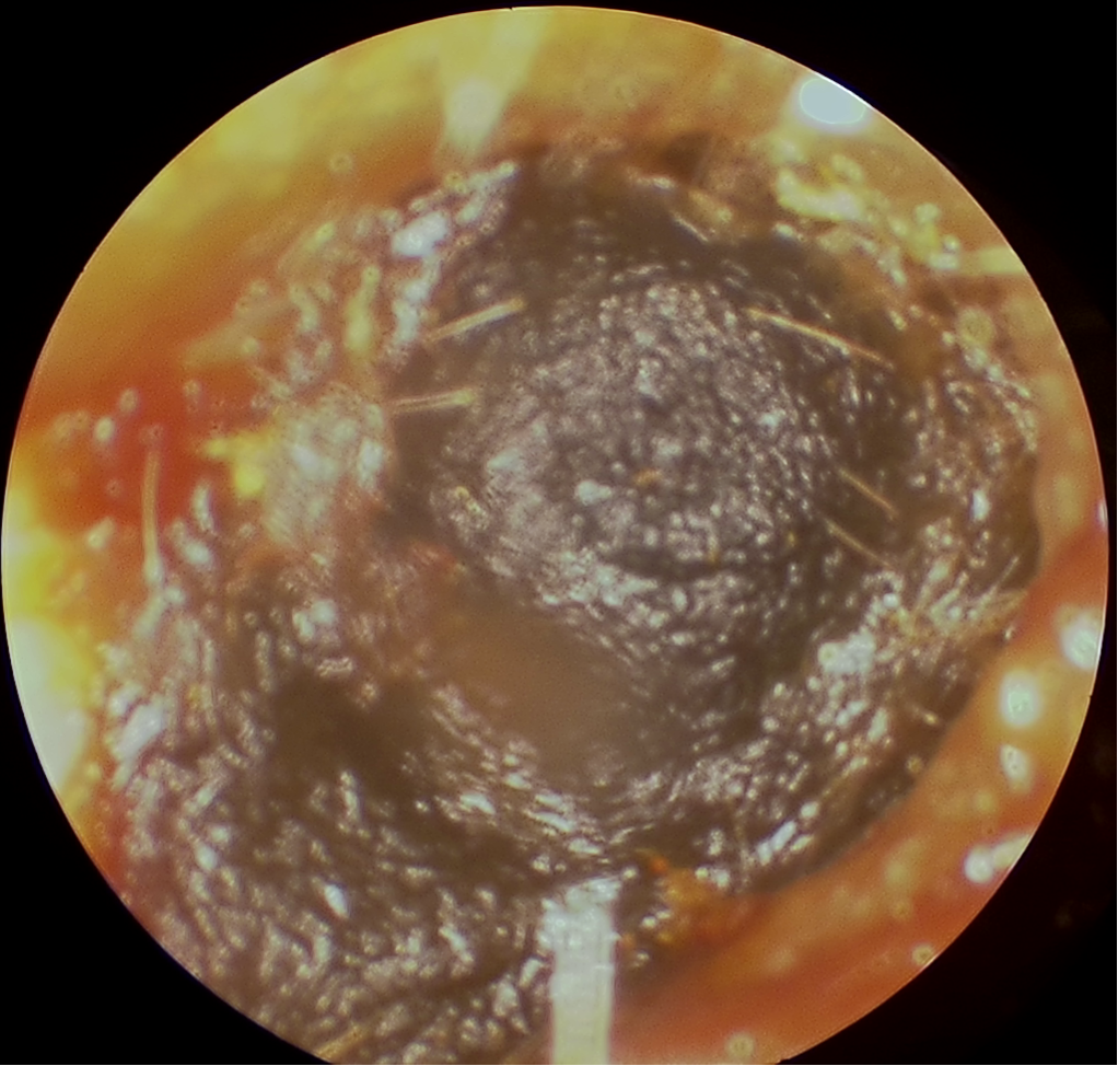 The inside of a person’s ear. It is blocked with ear wax.