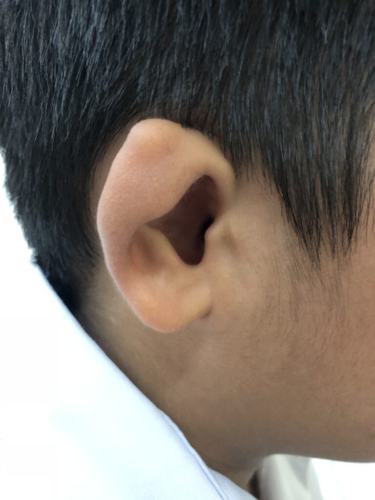Pinna is a slightly different shape. It is pointed at the top and larger than typical ear canal.