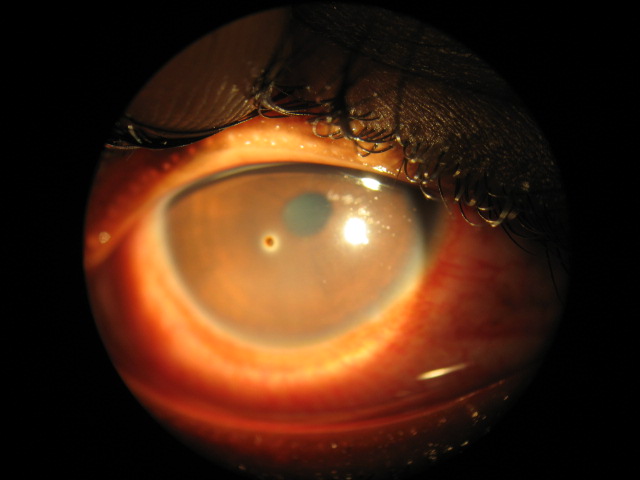 A small foreign body on the coloured part of the eye.