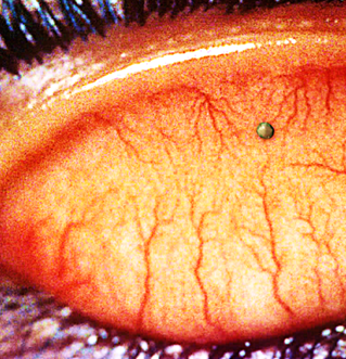 A small foreign body visible on white part of the eye.