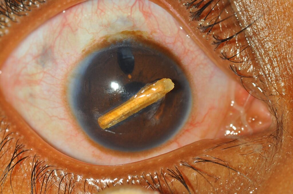 An eye with a wooden splinter in the coloured part of the eye.