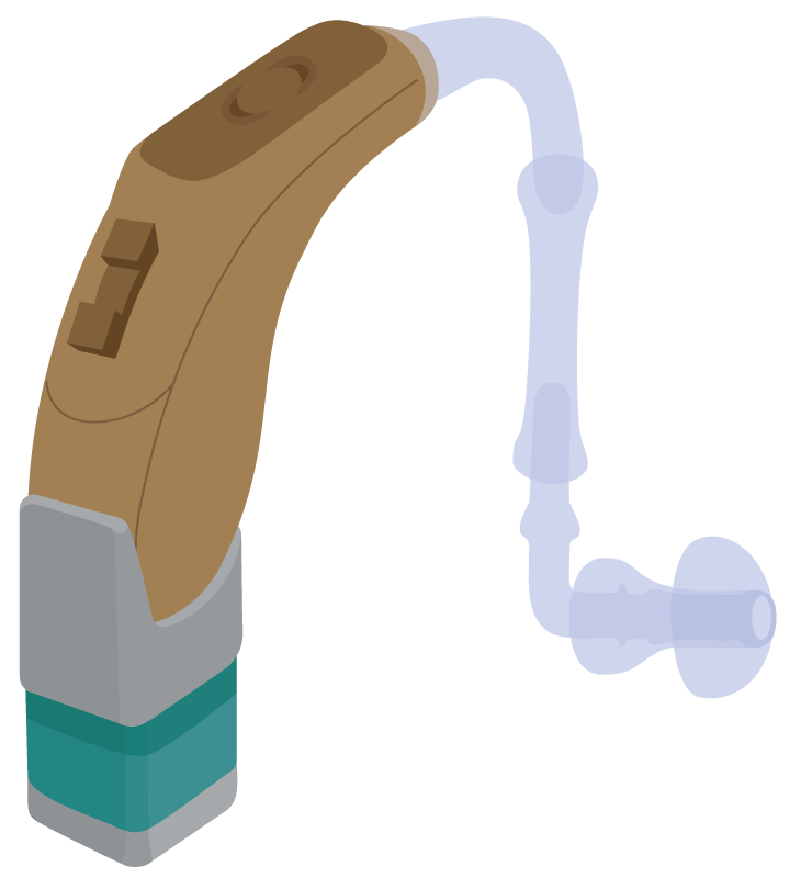 Remote microphone receiver connected to audioshoe at base of a behind-the-ear hearing aid with standard earmould.